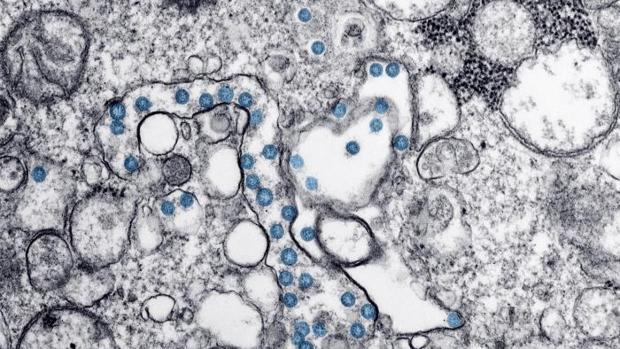 La ‘misteriosa’ proliferación de trombos en los enfermos de Covid-19