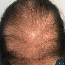 Alopecia androgénica