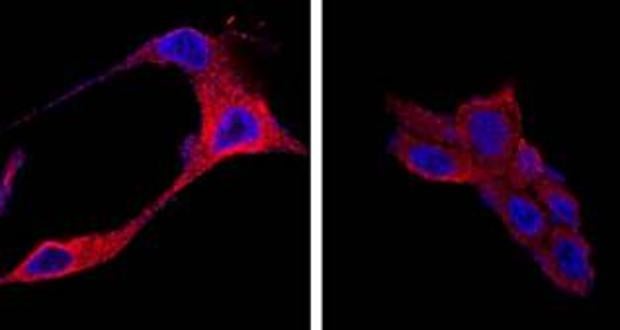 Un nuevo tratamiento para el cáncer de próstata usa nanopartículas orgánicas para destruir las células tumorales