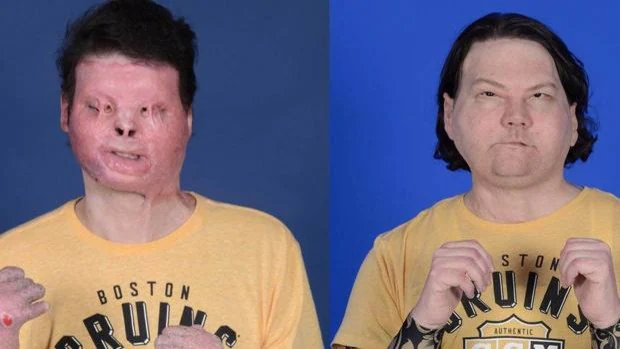 Un equipo en Nueva York realiza el primer trasplante de cara y doble de manos