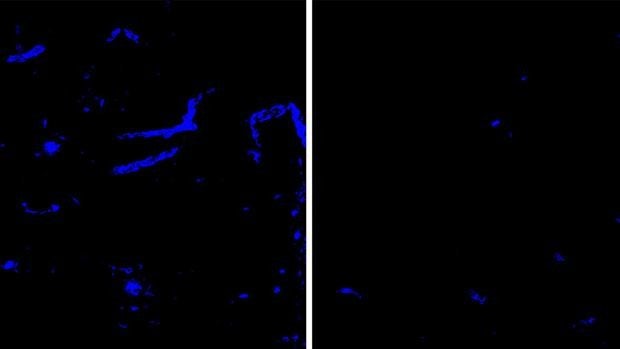 Un anticuerpo elimina las placas de una proteína clave en alzhéimer