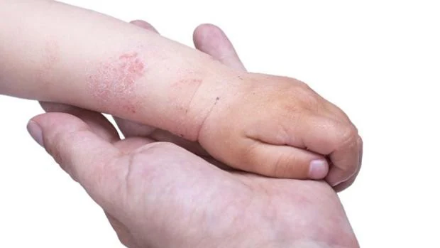 pedal Amplificar lucha Qué tratamientos hay para la dermatitis atópica?