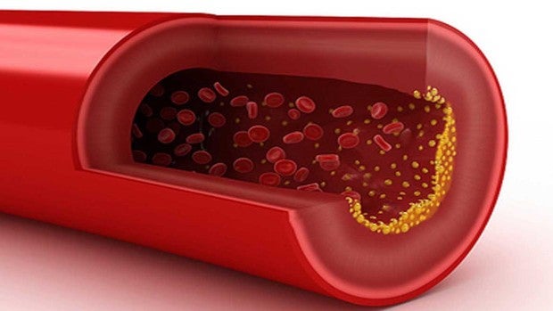 Los plásticos elevan el colesterol y pueden causar enfermedades cardiovasculares