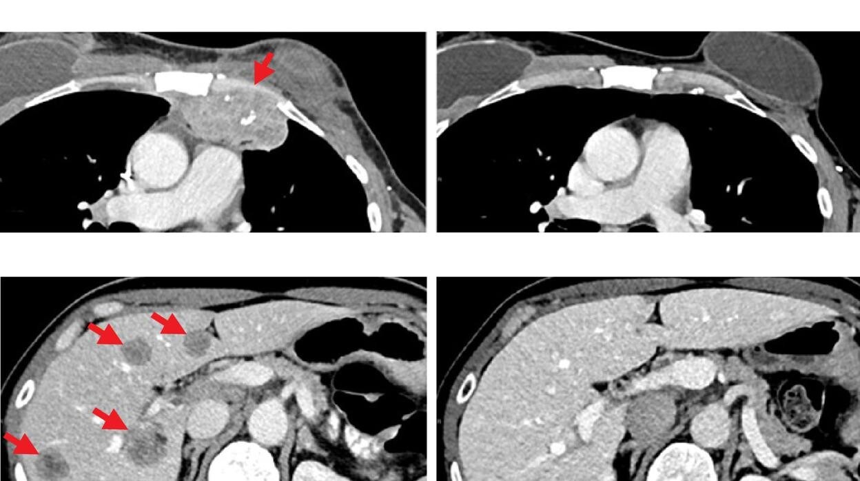 Mujer con cáncer de mama con lesiones metastásicas en la pared torácica (arriba, izquierda) y el hígado (abajo, izquierda). Después de recibir la inmunoterapia, los tumores se redujeron por completo. Escaneos recientes (R) muestran que ella está libre de cáncer 5 años después