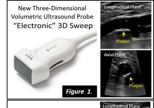 Ecografía 3D matrix, nueva herramienta para prevenir el daño del corazón en personas sanas