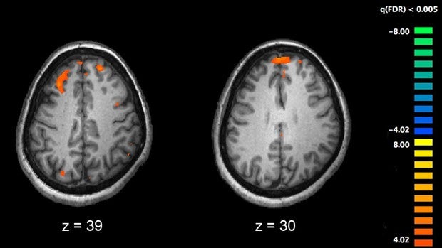 Un fallo en la comunicación de las neuronas causa la esquizofrenia