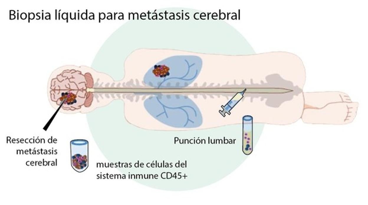 Biopsia líquida para metástsis cerebral