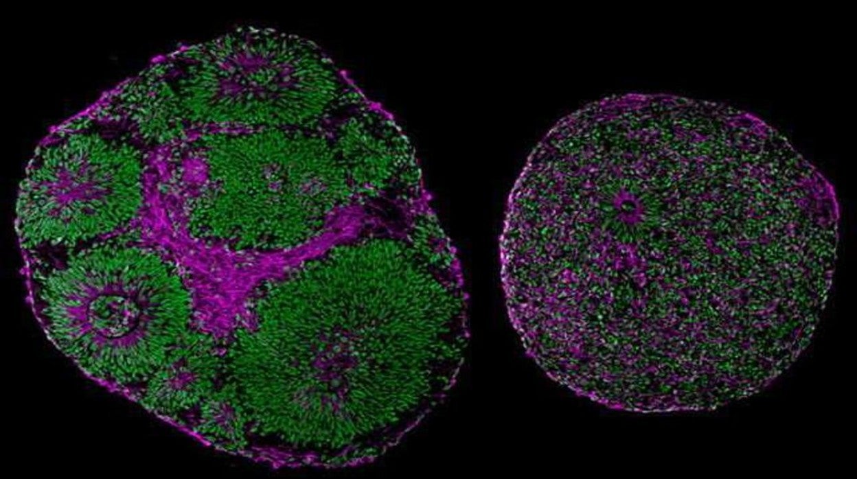 Las imágenes microscópicas revelan diferencias significativas en el tamaño y la estructura entre los organoides cerebrales derivados de un paciente con síndrome de Pitt-Hopkins (derecha) y de un control (izquierda).