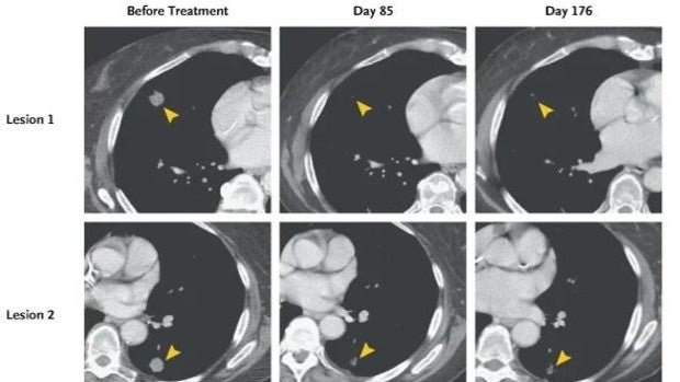 Reprograman las células de una paciente para atacar un mortal cáncer de páncreas