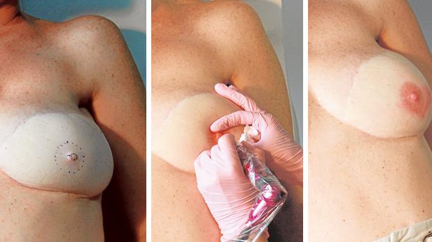 Faltan cirujanos plásticos para la reconstrucción de los pechos