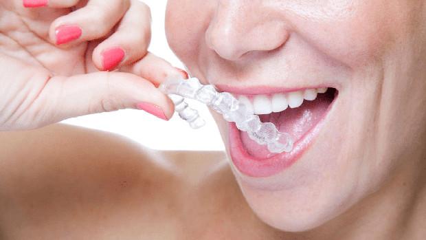Estas son las ventajas por las que cada vez más gente prefiere usar ortodoncia invisible