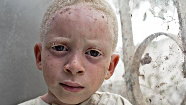 Los albinos apenas tienen un 10-15 % de agudeza visual