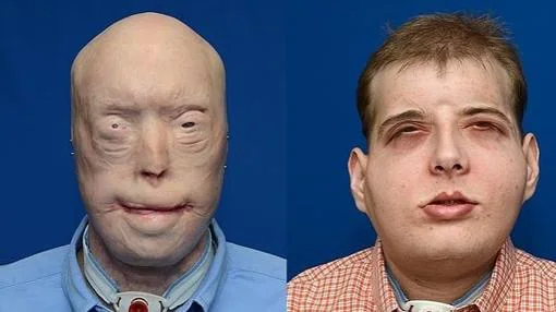 La nueva vida de Patrick Hardison, el hombre sin rostro que se sometió a un trasplante total de cara