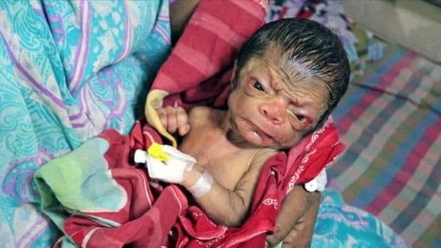El bebé de Bangladesh que tiene cara de anciano y pelo en la espalda