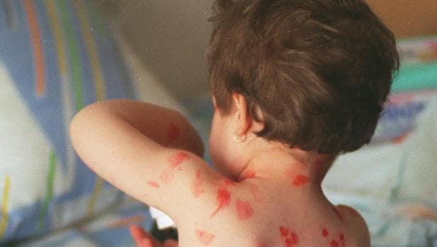 Una niña, curada de las erupciones producidas por la viruela