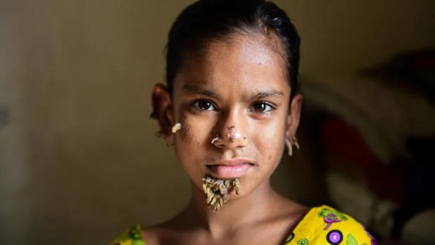 Sahana Khatun, de 10 años, diagnosticada con la enfermedad del «hombre árbol»