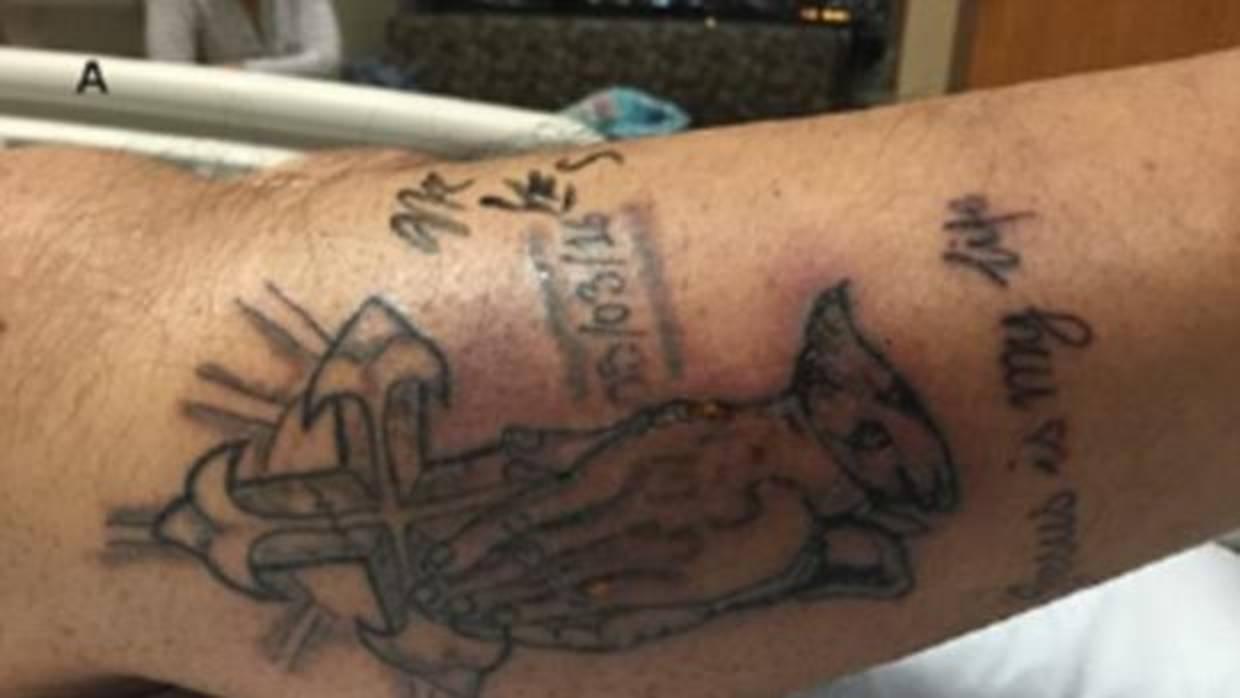 Un hombre muere tras infectarse en el mar su tatuaje recién hecho