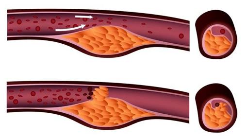 Efecto del colesterol sobre las arterias