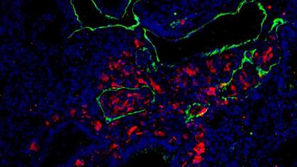 Células con melanoma metastásico (rojo) en los vasos linfáticos de un pulmón (verde)