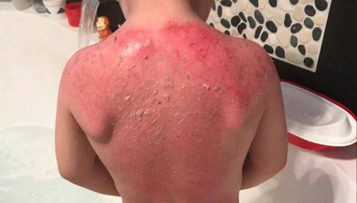 Un niño de tres años sufre graves quemaduras tras usar un protector solar de Peppa Pig