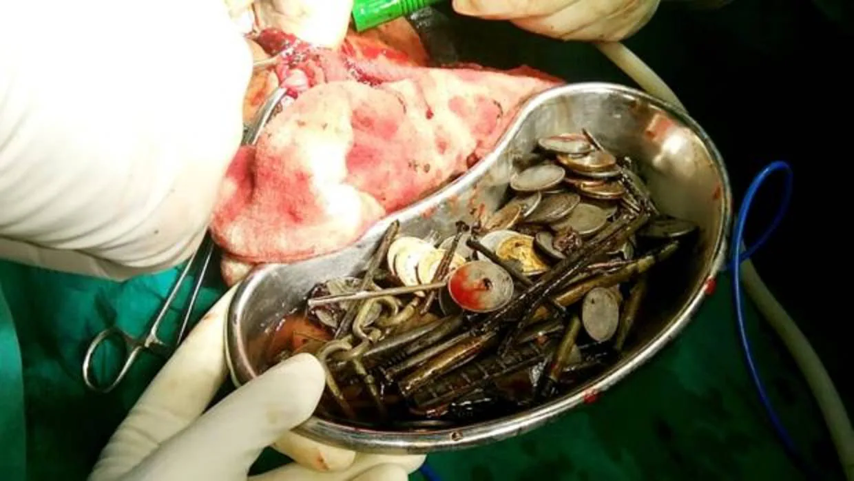 Monedas, tornillos y tuercas que se había tragado el paciente y que los cirujanos lograron extraer del estómago