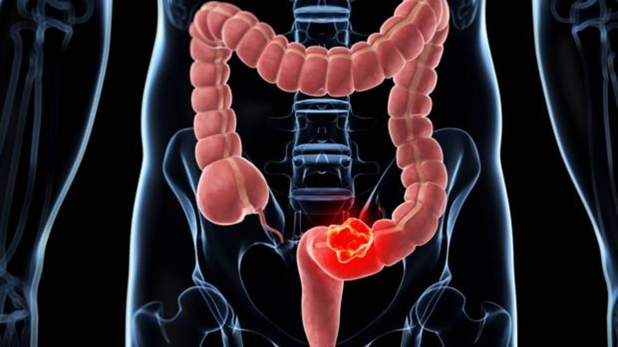 Recreación artística de cómo sería un tumor de colon