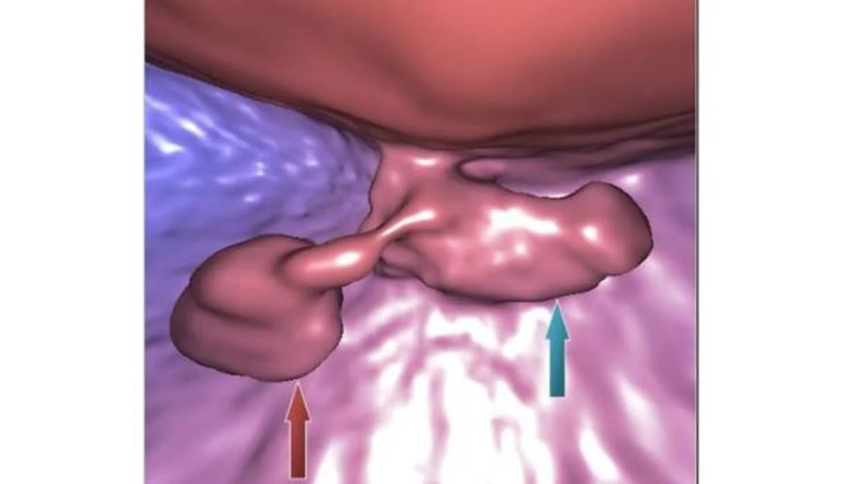 Embrión humano recién implantado en el útero, visualizado mediante la técnica de embrioscopia ecográfica virtual desarrollada en la clínica MARGen de Granada. El cuerpo del embrión (flecha azul) y el saco vitelino (flecha roja) están conectados mediante el ducto vitelino