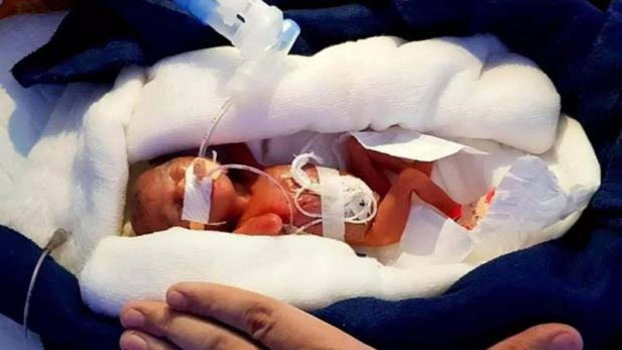 El «milagro» de la niña prematura que pesaba 400 gramos cuando nació y ha conseguido sobrevivir