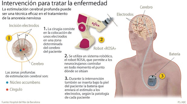 Prueban, con éxito, la estimulación eléctrica contra la anorexia