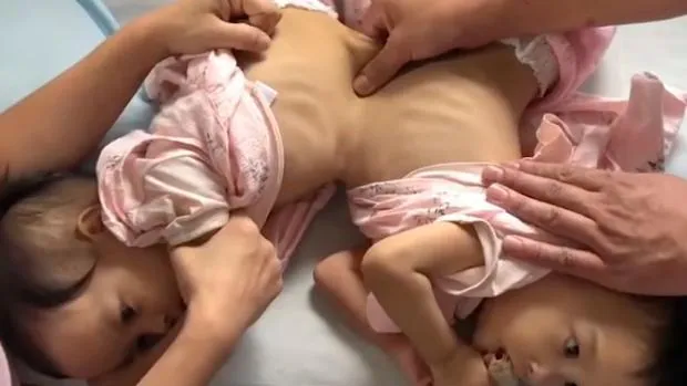 Un hospital australiano intentará separar a dos siamesas unidas por abdomen y tórax
