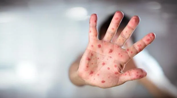 Un hombre que contrajo el sarampión en Tailandia contagia a tres personas más en Vizcaya