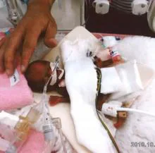 El bebé más pequeño del mundo al nacer deja el hospital en Japón