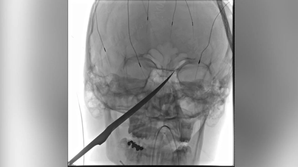 Radiografía que muestra el cuchillo clavado en el rostro de Eli Gregg