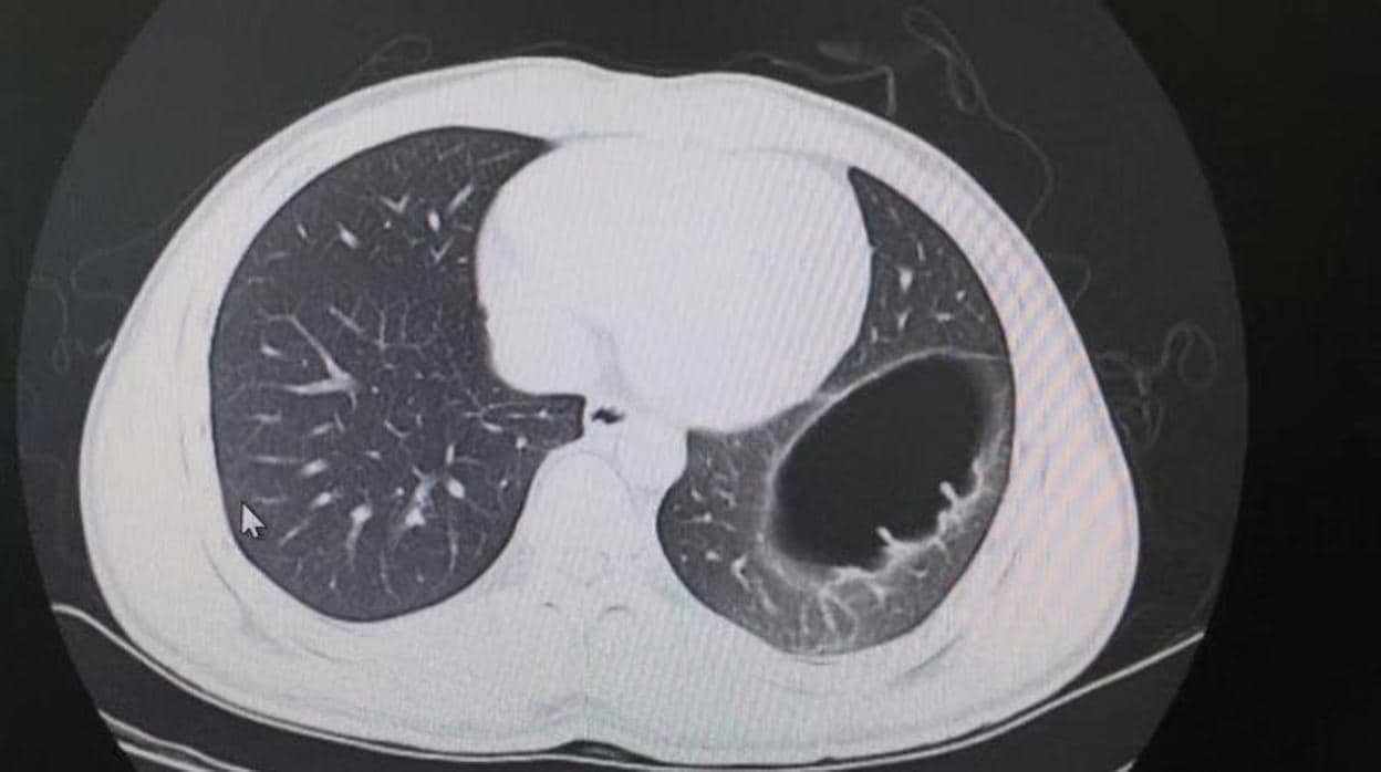 Una tomografía computarizada que muestra la hernia diafragmática del joven