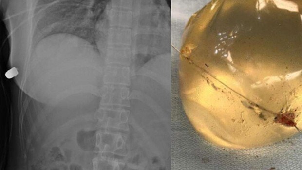 Una mujer se salva de morir de un disparo gracias a que su implante mamario de silicona desvió la bala