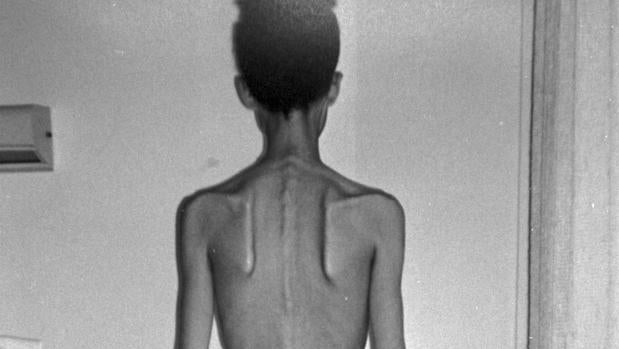 Personas con anorexia y bulimia, atrapadas por un doble confinamiento