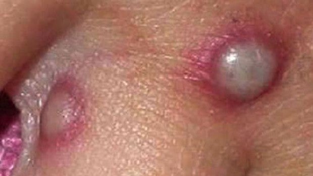 Sanidad confirma siete casos de la viruela del mono e investiga 22 más