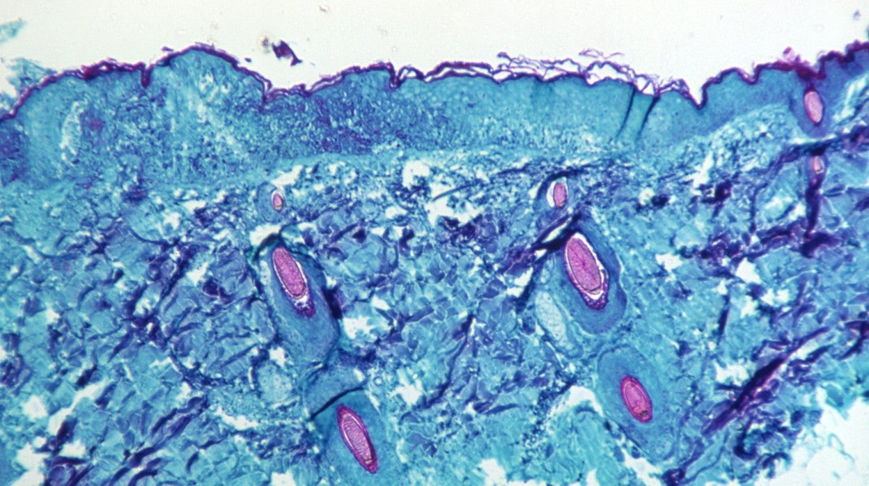 Una sección de tejido de la piel, extraída de una lesión en la piel de un mono, que había sido infectado con el virus de la viruela del simio