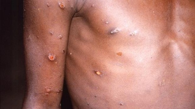 Sanidad eleva a 51 el total de casos positivos de viruela del mono