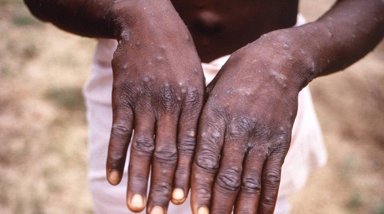 Un niño con viruela del mono en la República Democrática del Congo