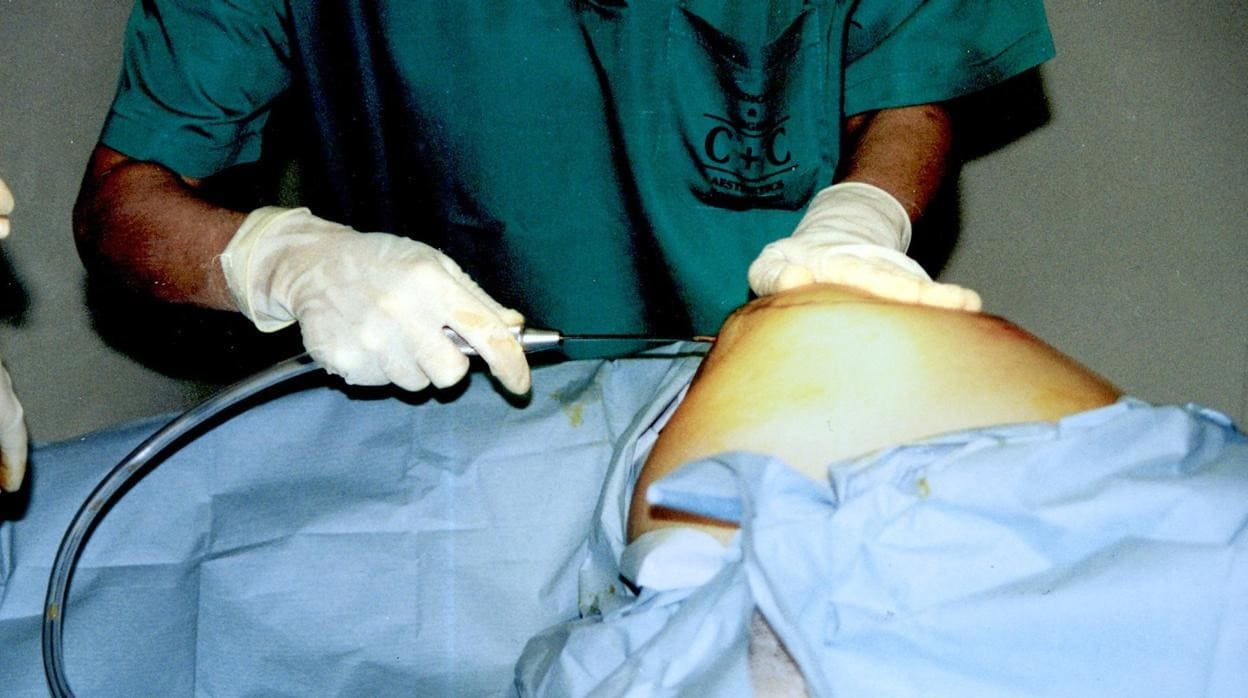 Las liposucciones son un 18,1% de las operaciones estéticas en España.