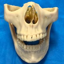 Biomodelo impreso en 3D de paciente con deformidad dentofacial